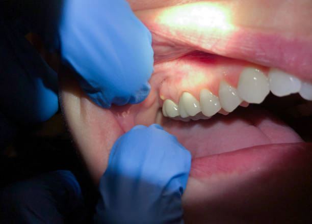 Best Emergency Wisdom Teeth Removal in Oberlin, LA